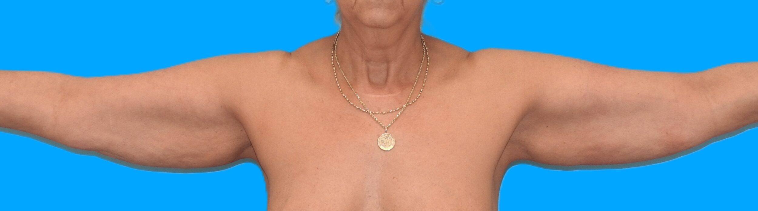 Before Image: Patient Case #0135 - front