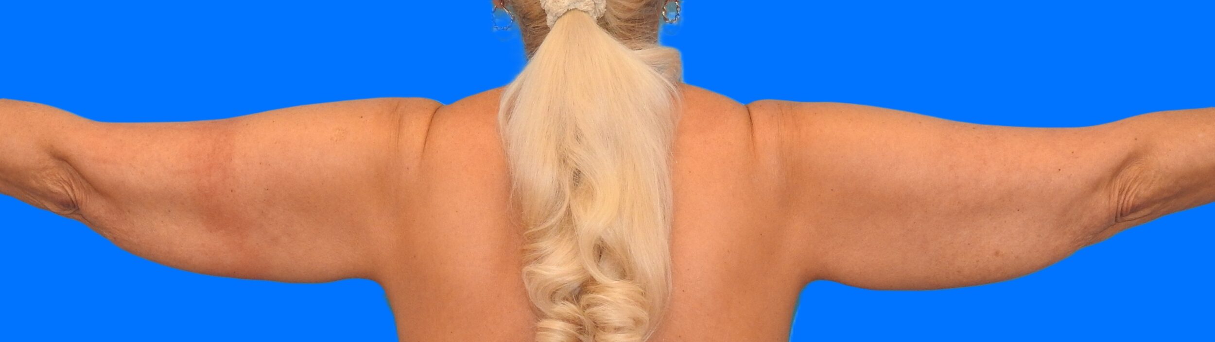 Before Image: Patient Case #0135 - back