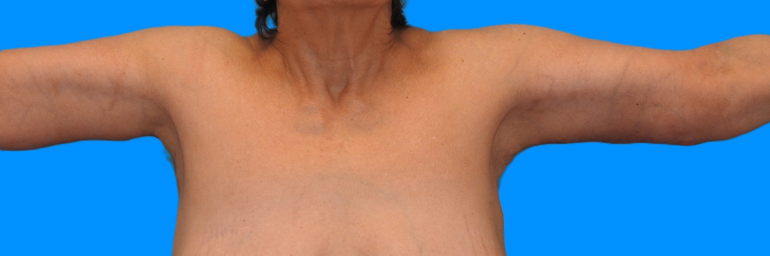 After Image: Patient Case #0136 - front