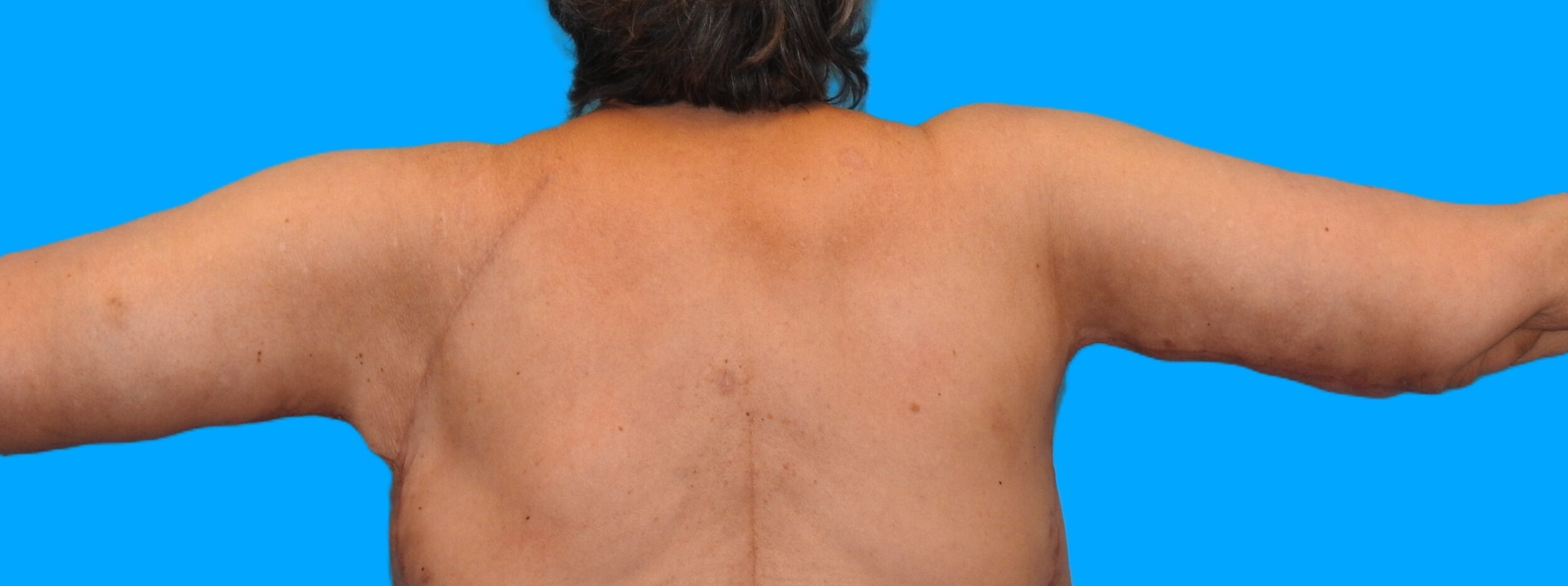 After Image: Patient Case #0136 - back