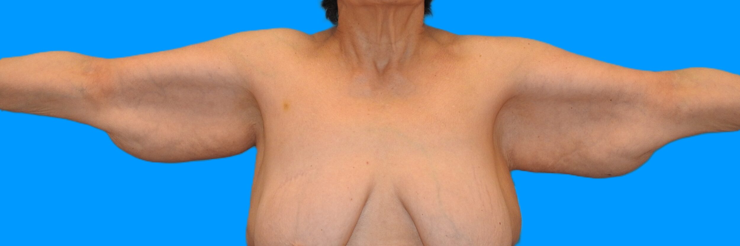 Before Image: Patient Case #0136 - front