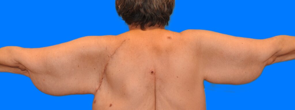 Before Image: Patient Case #0136 - back