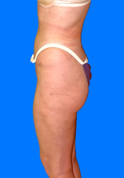 After Image: Patient Case #0137 - left-side