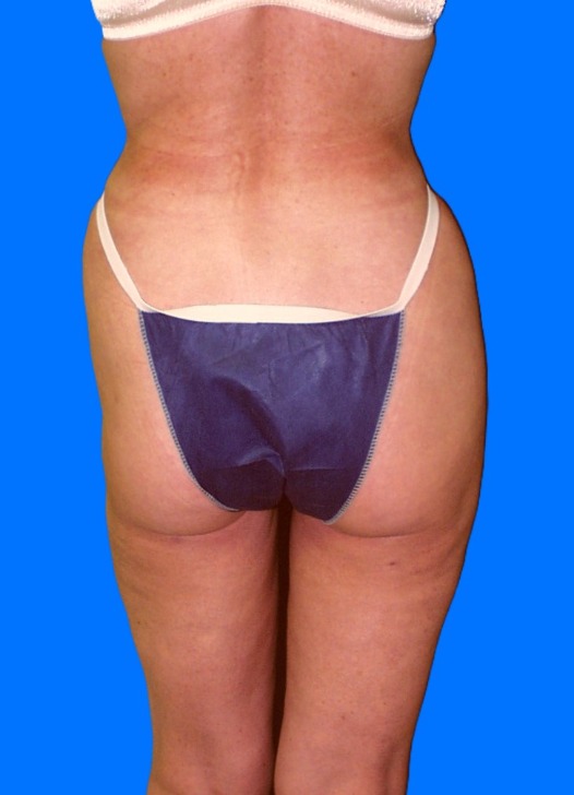 After Image: Patient Case #0137 - back