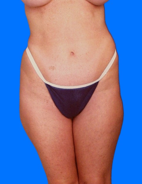 Before Image: Patient Case #0137 - front