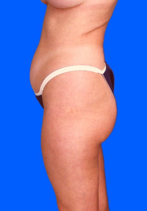 Before Image: Patient Case #0137 - left-side