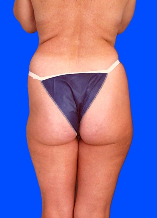 Before Image: Patient Case #0137 - back