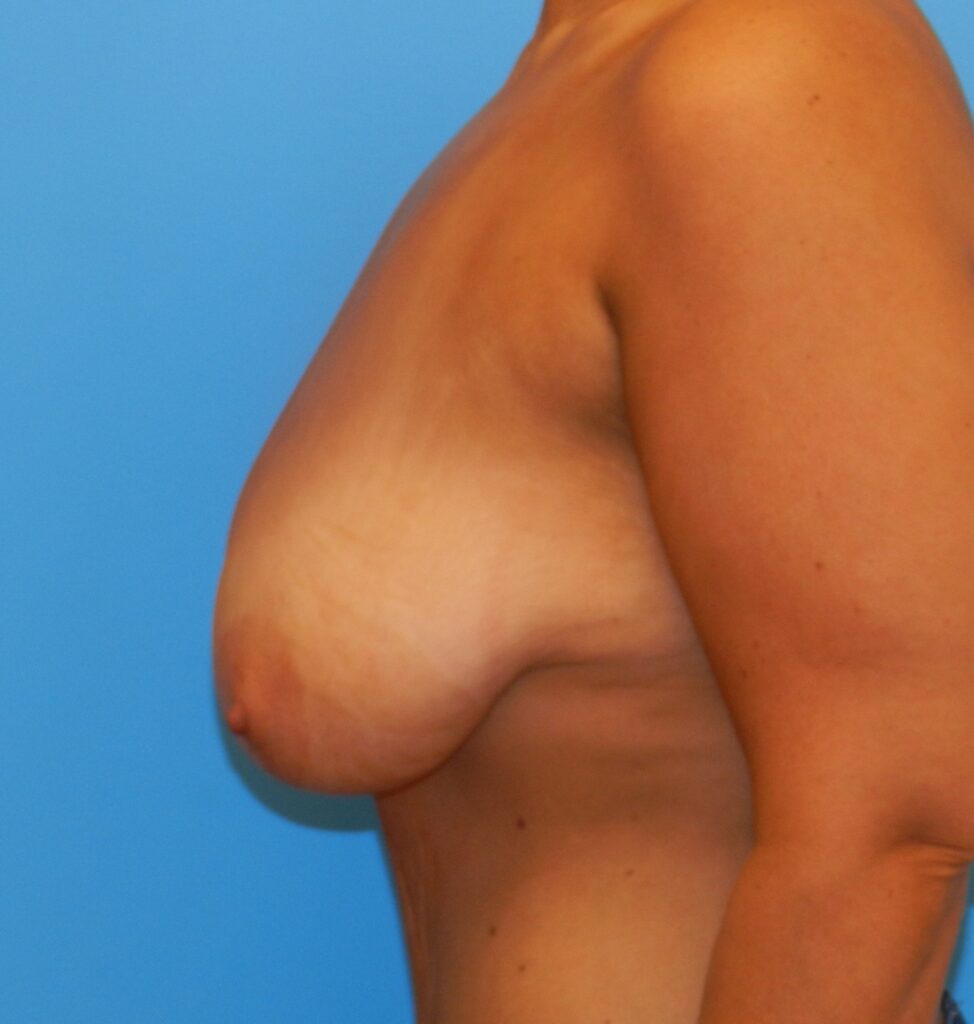 Before Image: Patient Case #0138 - left-side