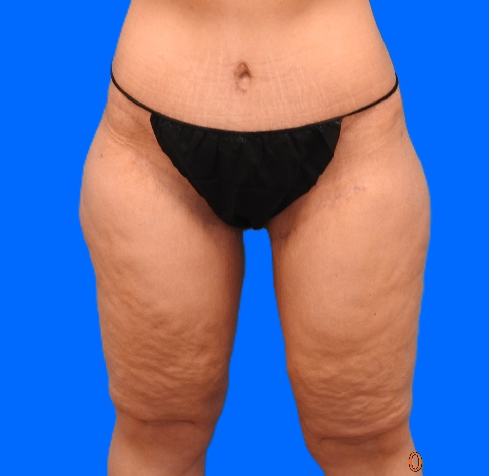 After Image: Patient Case #0139 - front