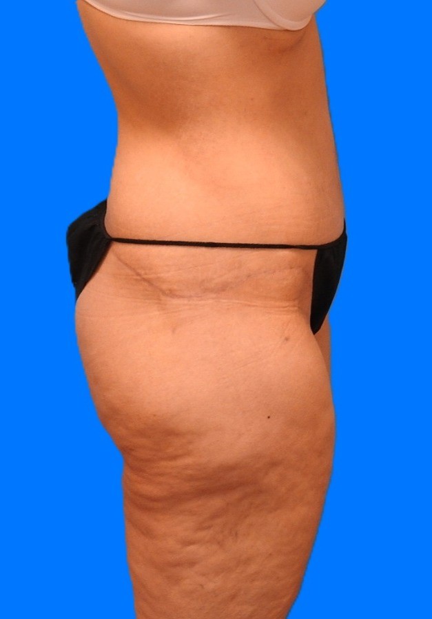 After Image: Patient Case #0139 - right-side