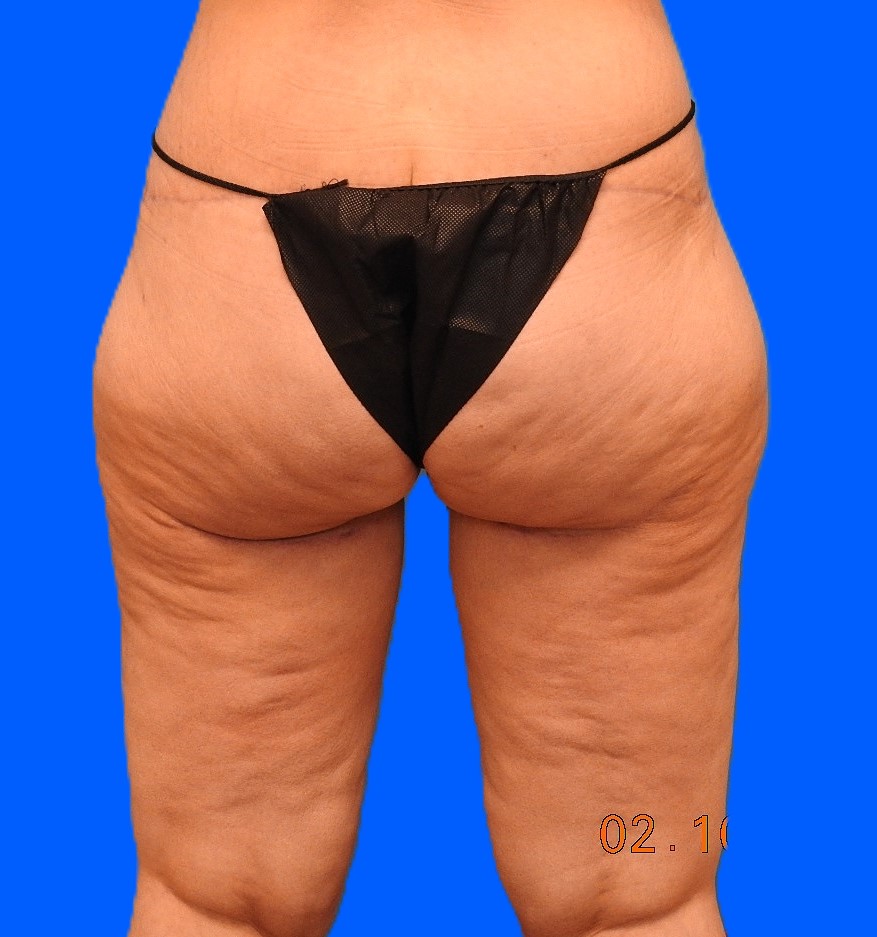 After Image: Patient Case #0139 - back