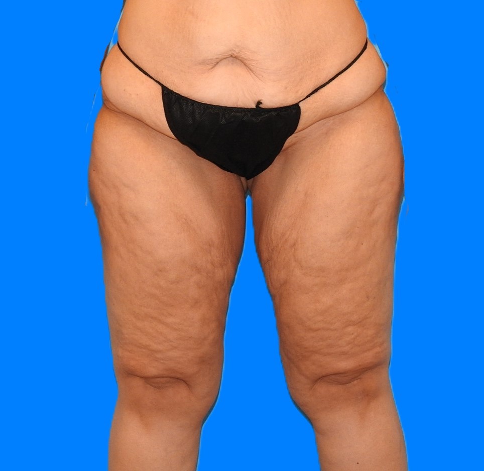 Before Image: Patient Case #0139 - front