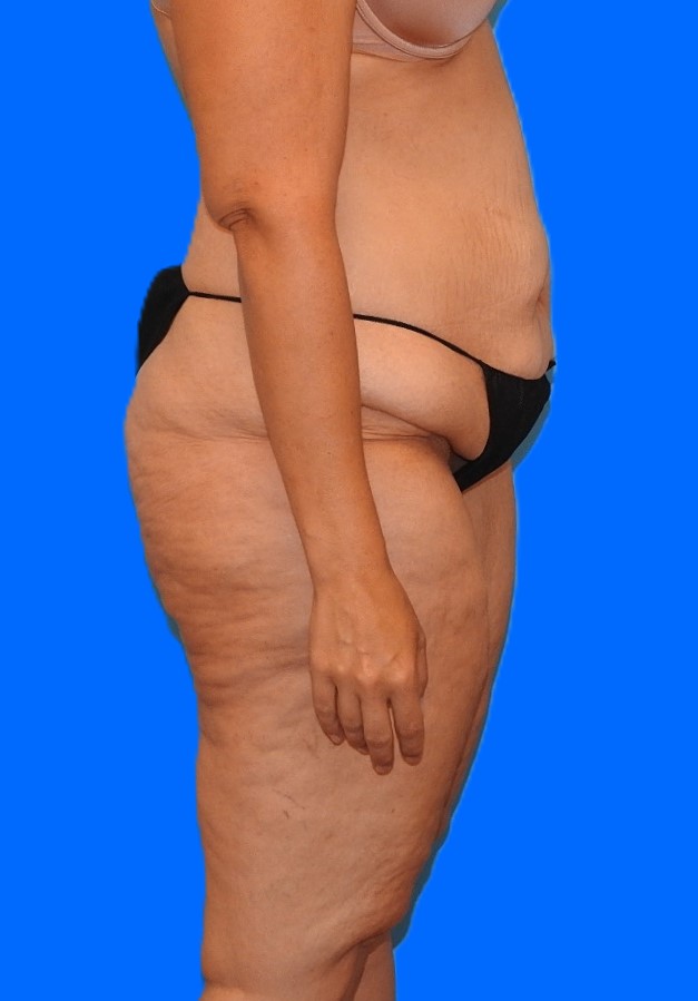 Before Image: Patient Case #0139 - right-side