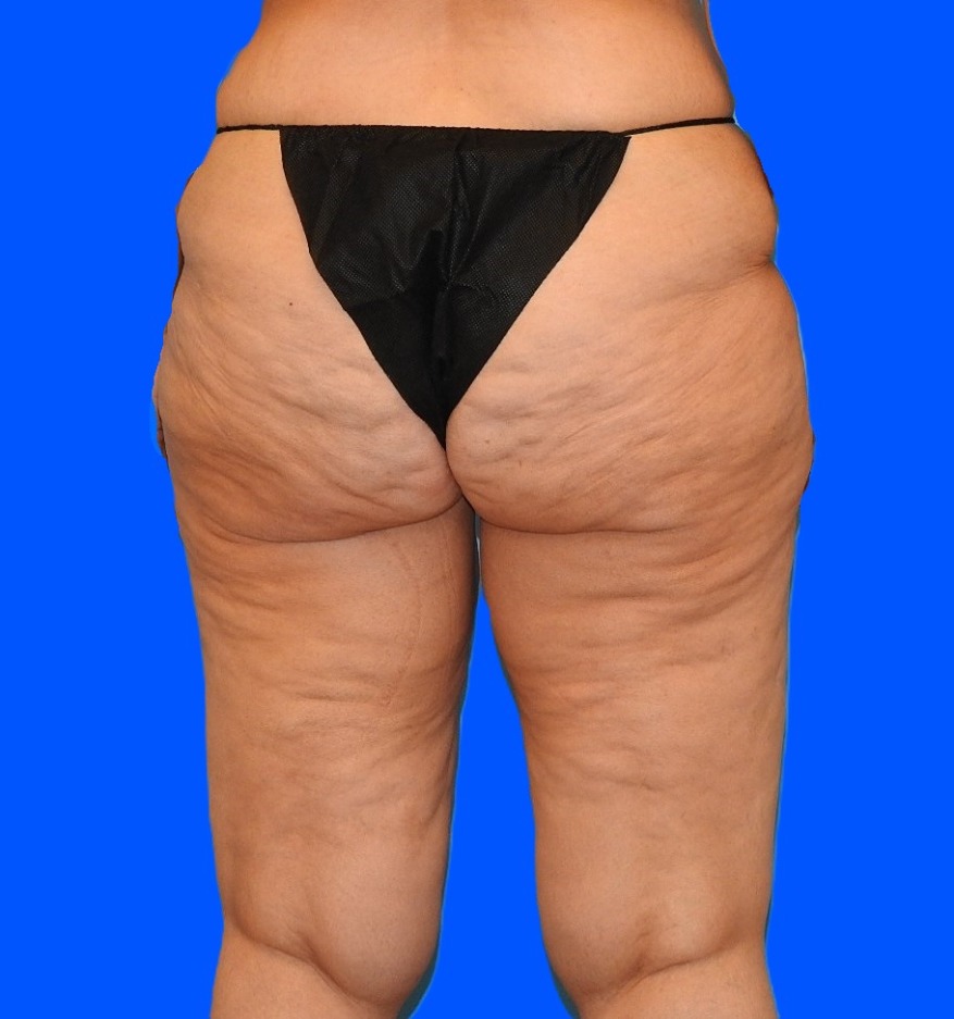 Before Image: Patient Case #0139 - back