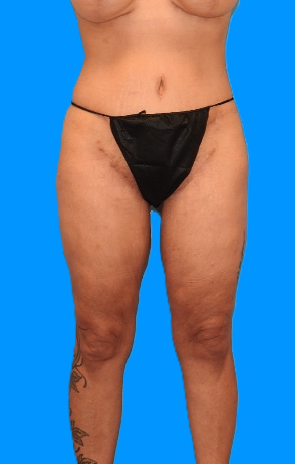 After Image: Patient Case #0140 - front
