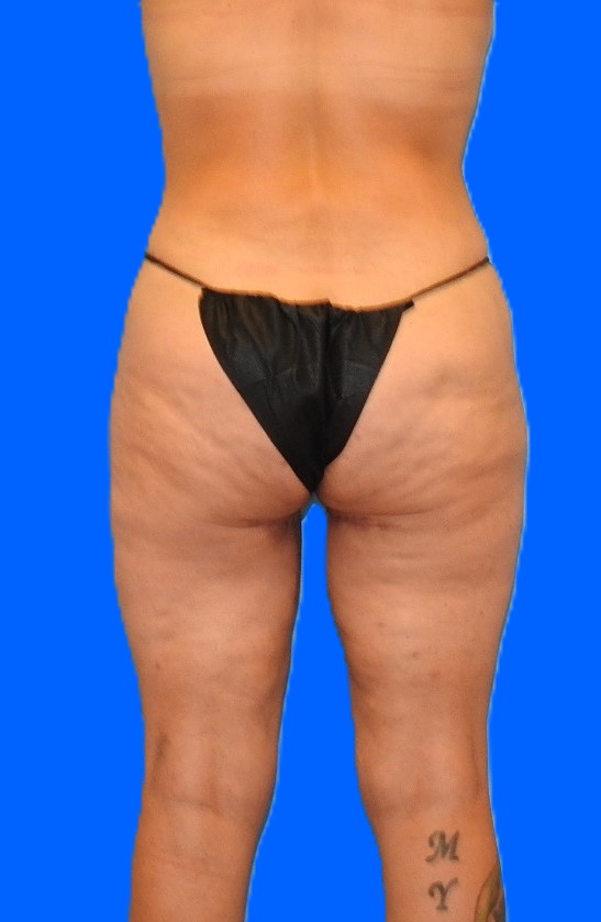 After Image: Patient Case #0140 - back