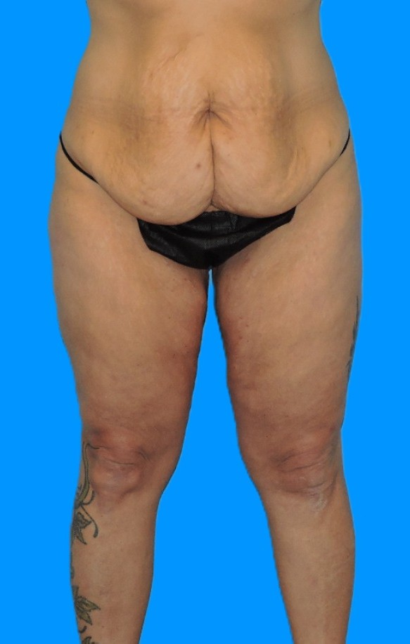 Before Image: Patient Case #0140 - front