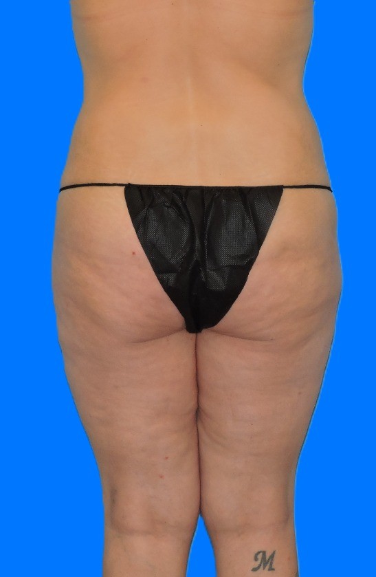 Before Image: Patient Case #0140 - back