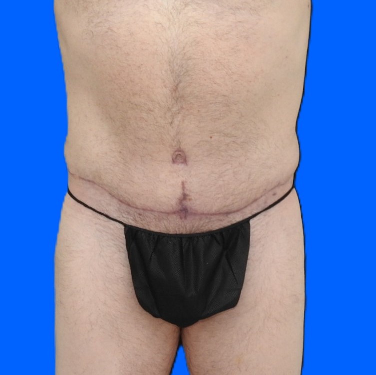 After Image: Patient Case #0141 - front