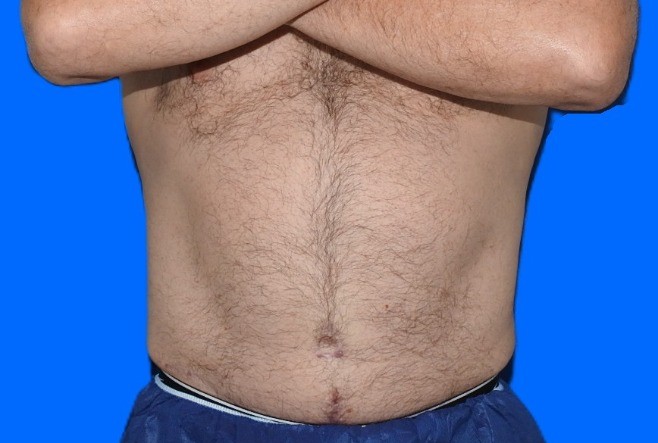 After Image: Patient Case #0141 - front