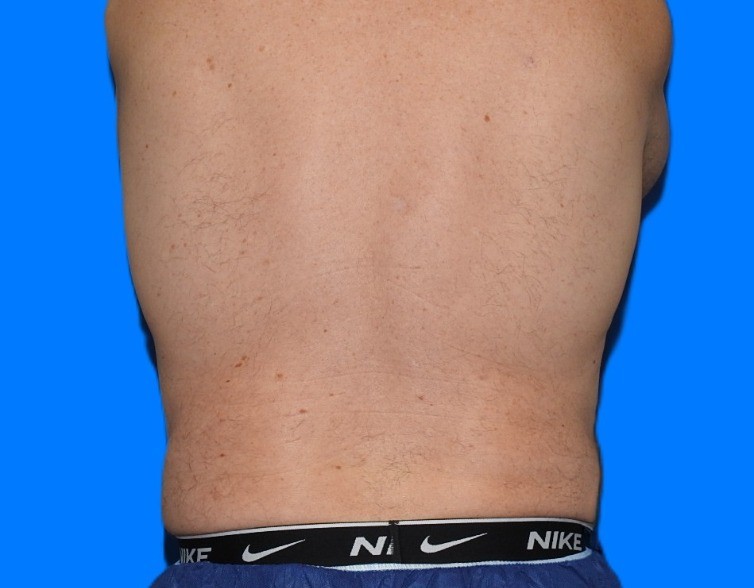 After Image: Patient Case #0141 - back