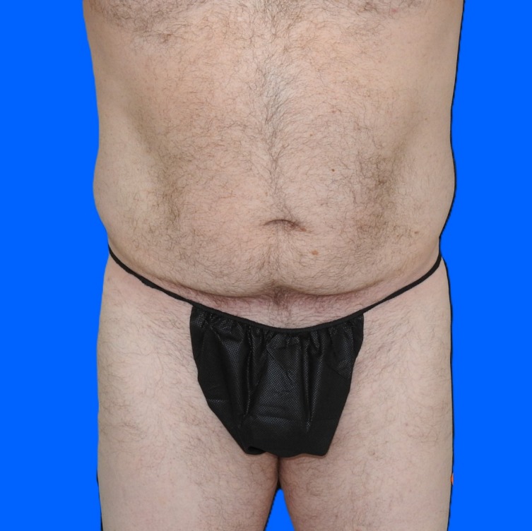 Before Image: Patient Case #0141 - front