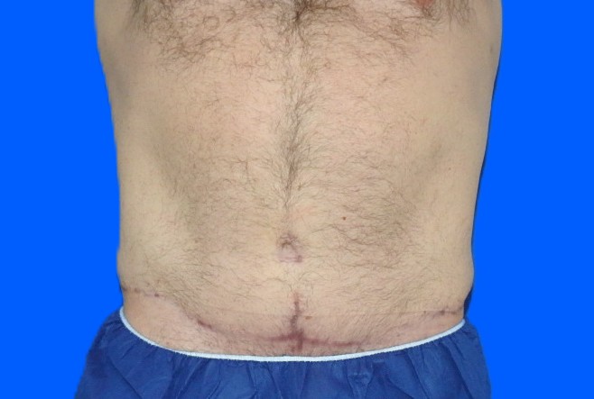 Before Image: Patient Case #0141 - front