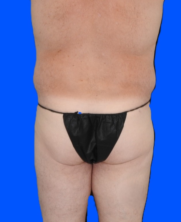 Before Image: Patient Case #0141 - back