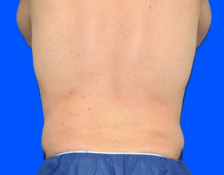 Before Image: Patient Case #0141 - back