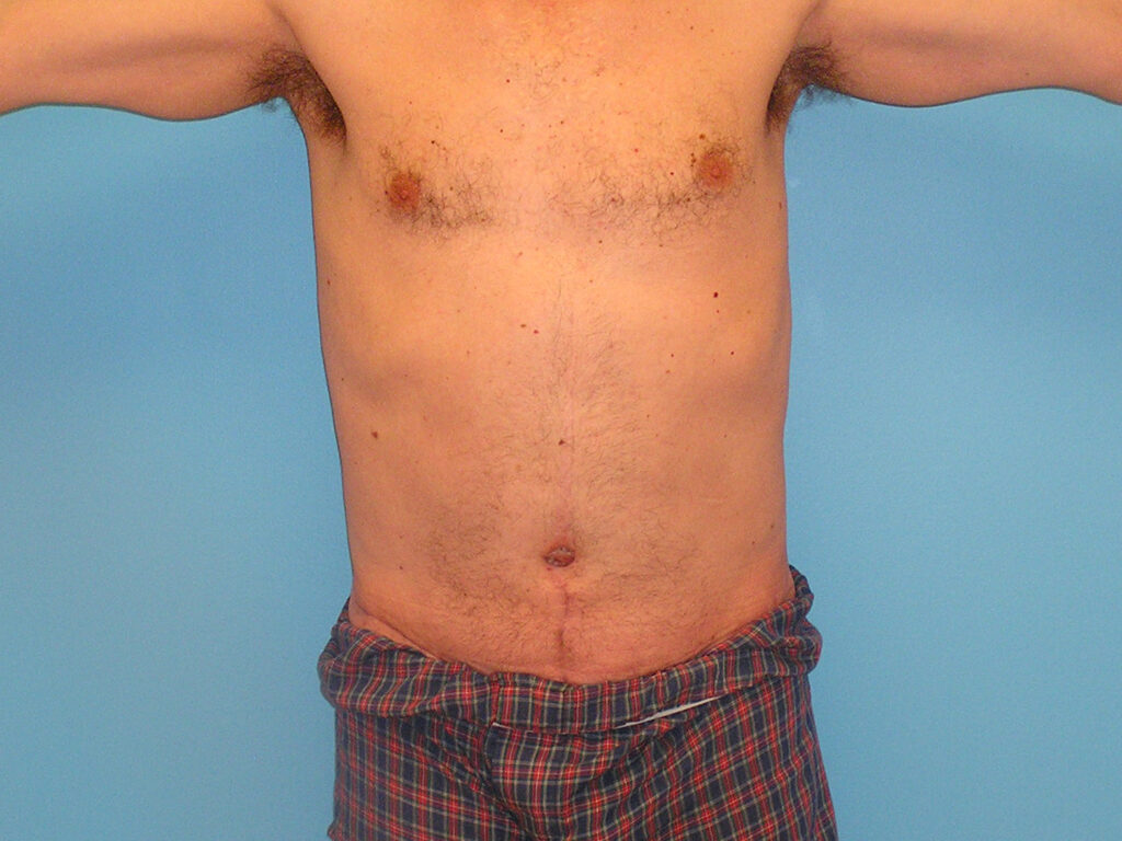 After Image: Patient Case #0142 - front