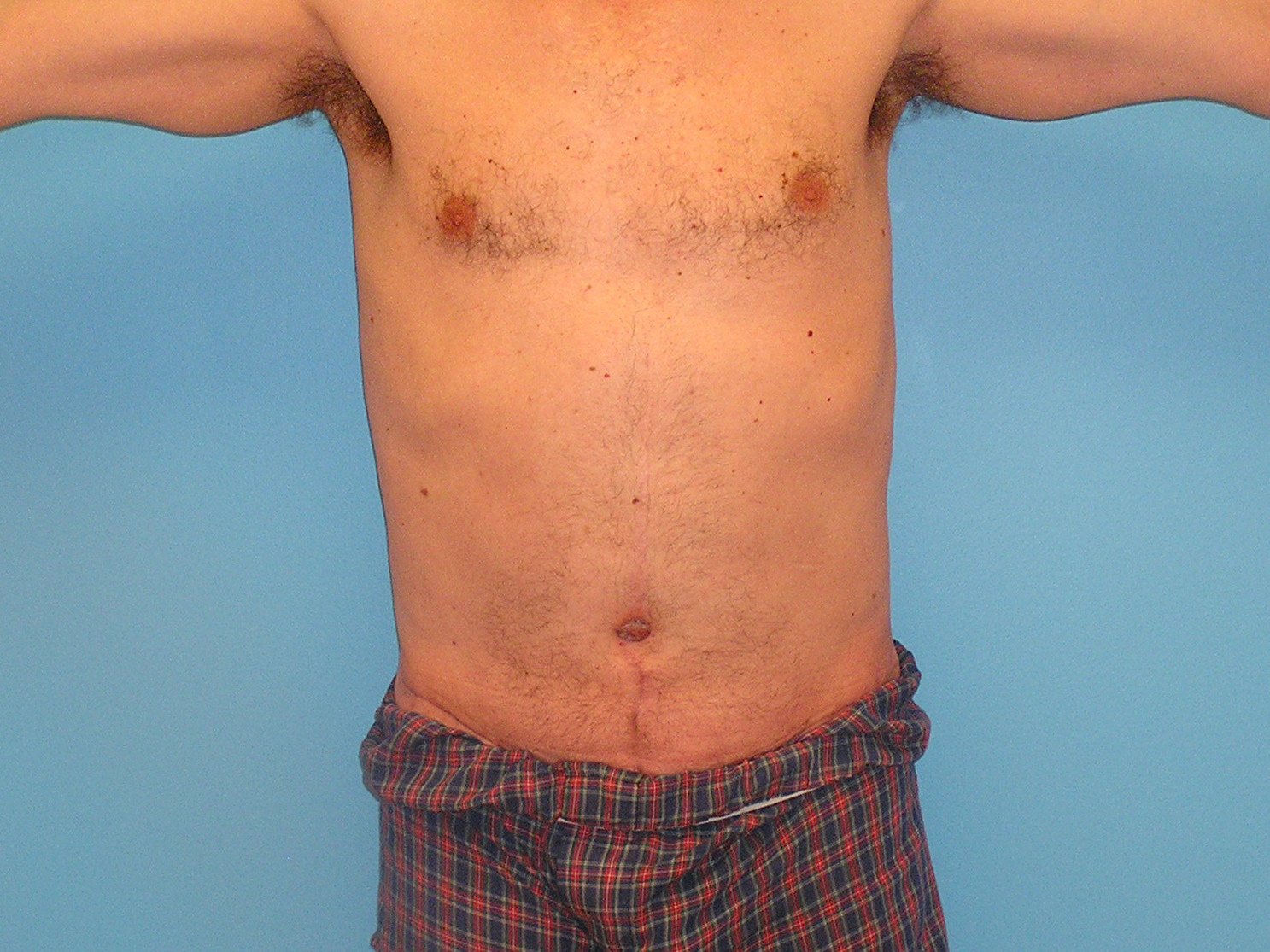 After Image: Patient Case #0142 - front