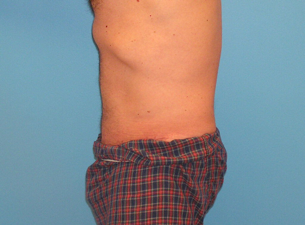 After Image: Patient Case #0142 - left-side
