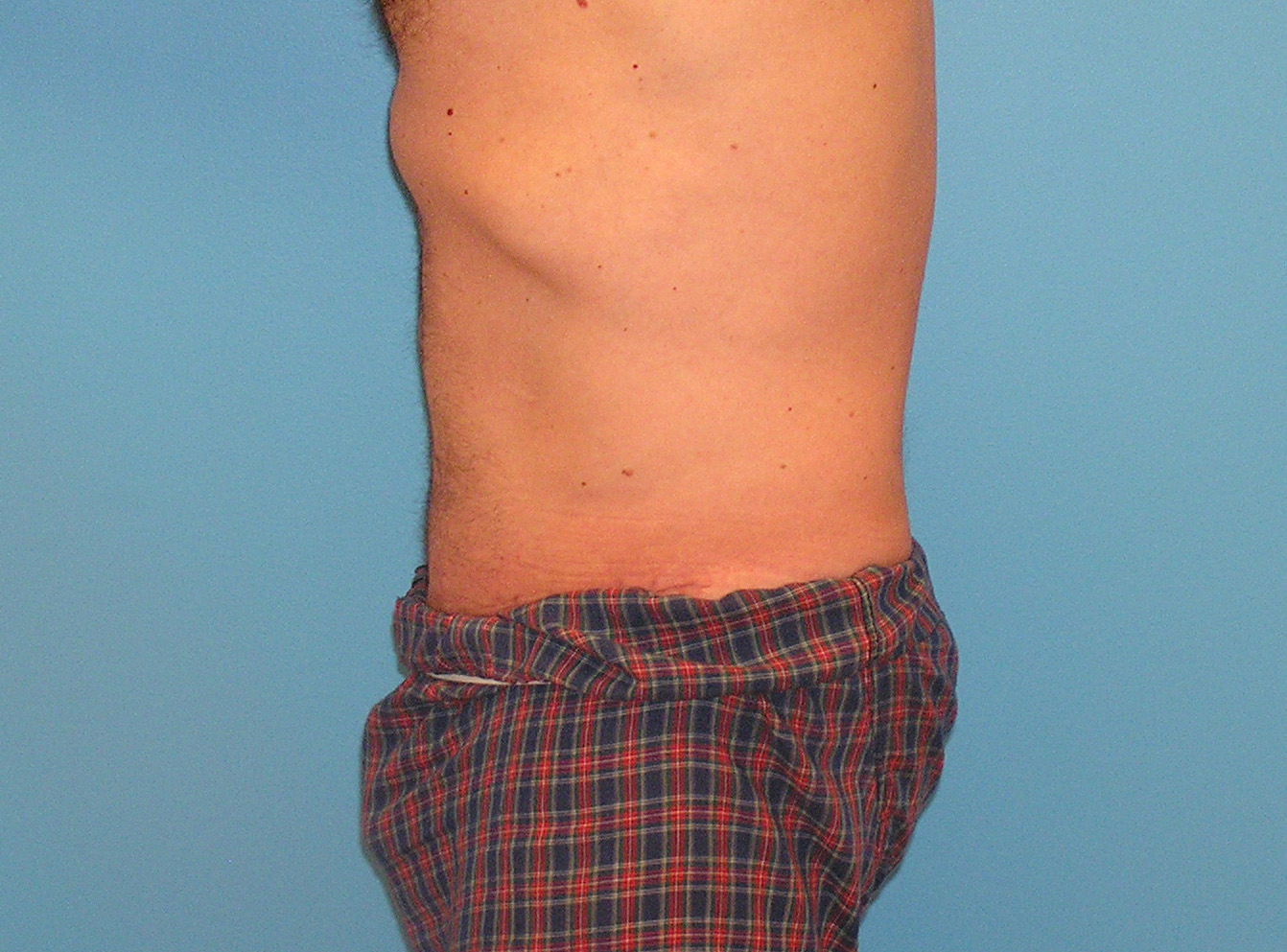 After Image: Patient Case #0142 - left-side