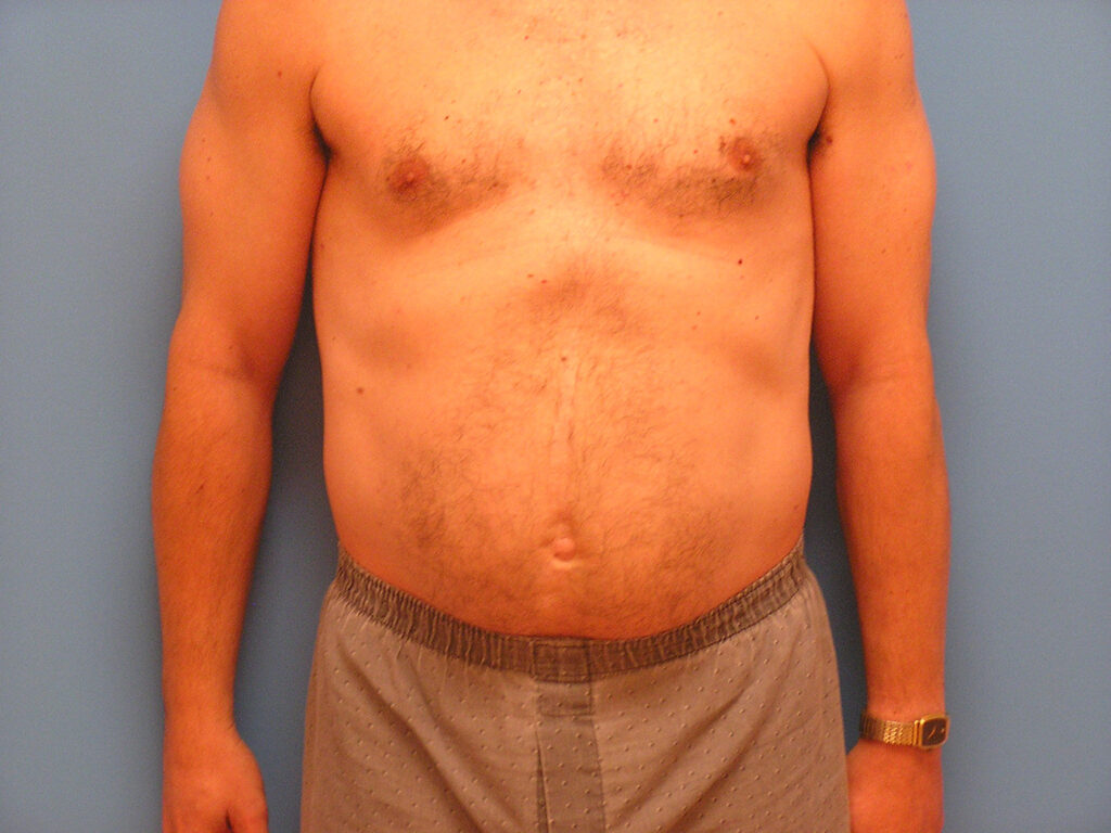 Before Image: Patient Case #0142 - front