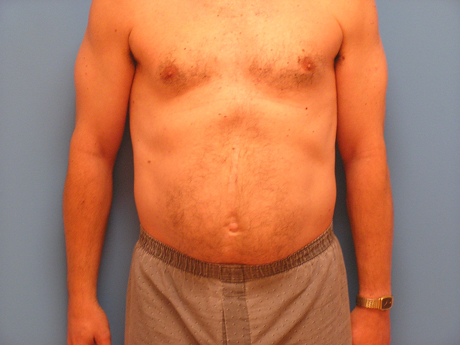 Before Image: Patient Case #0142 - front