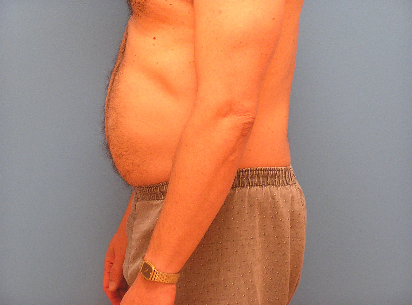 Before Image: Patient Case #0142 - left-side