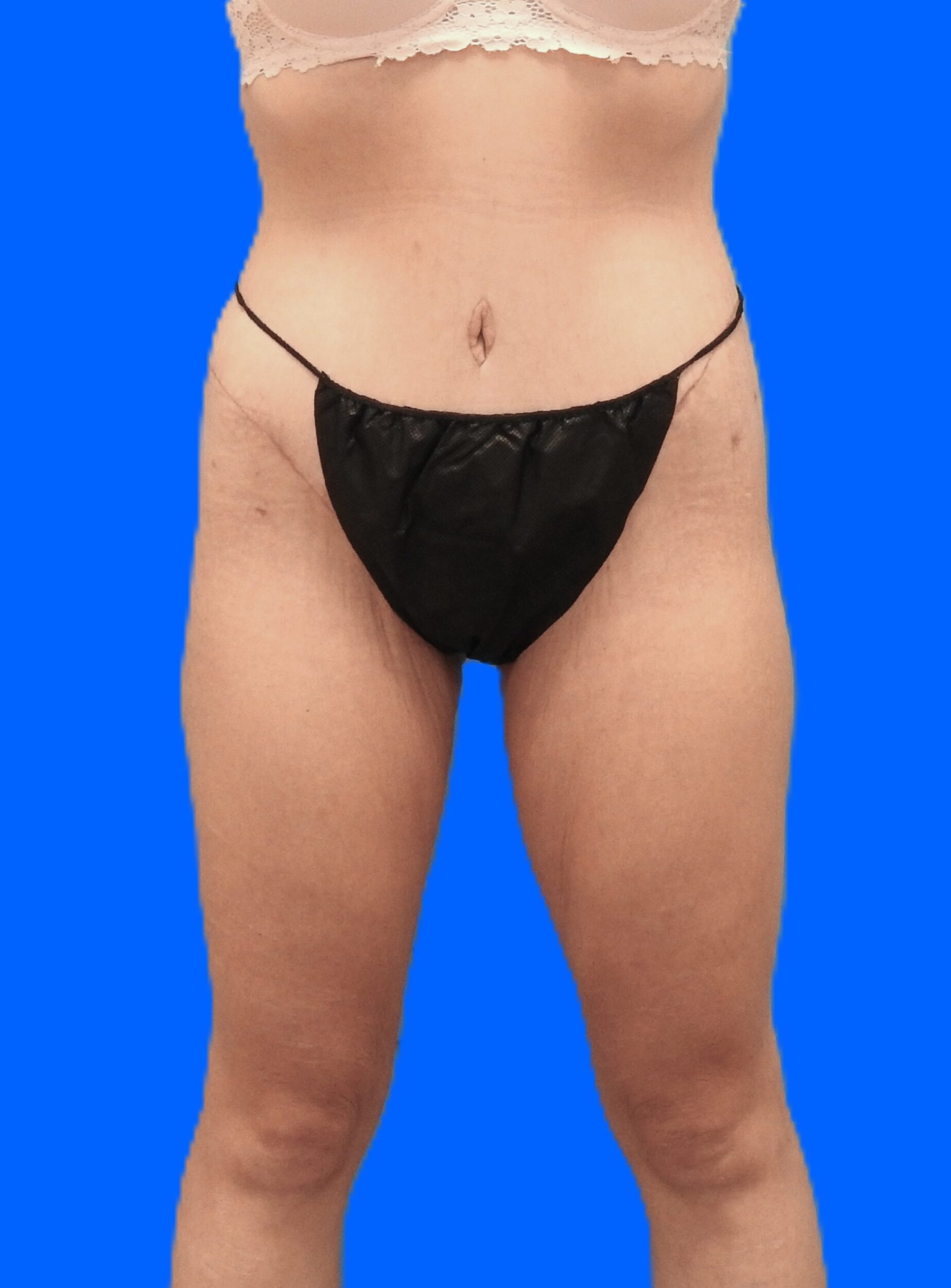 After Image: Patient Case #0144 - front