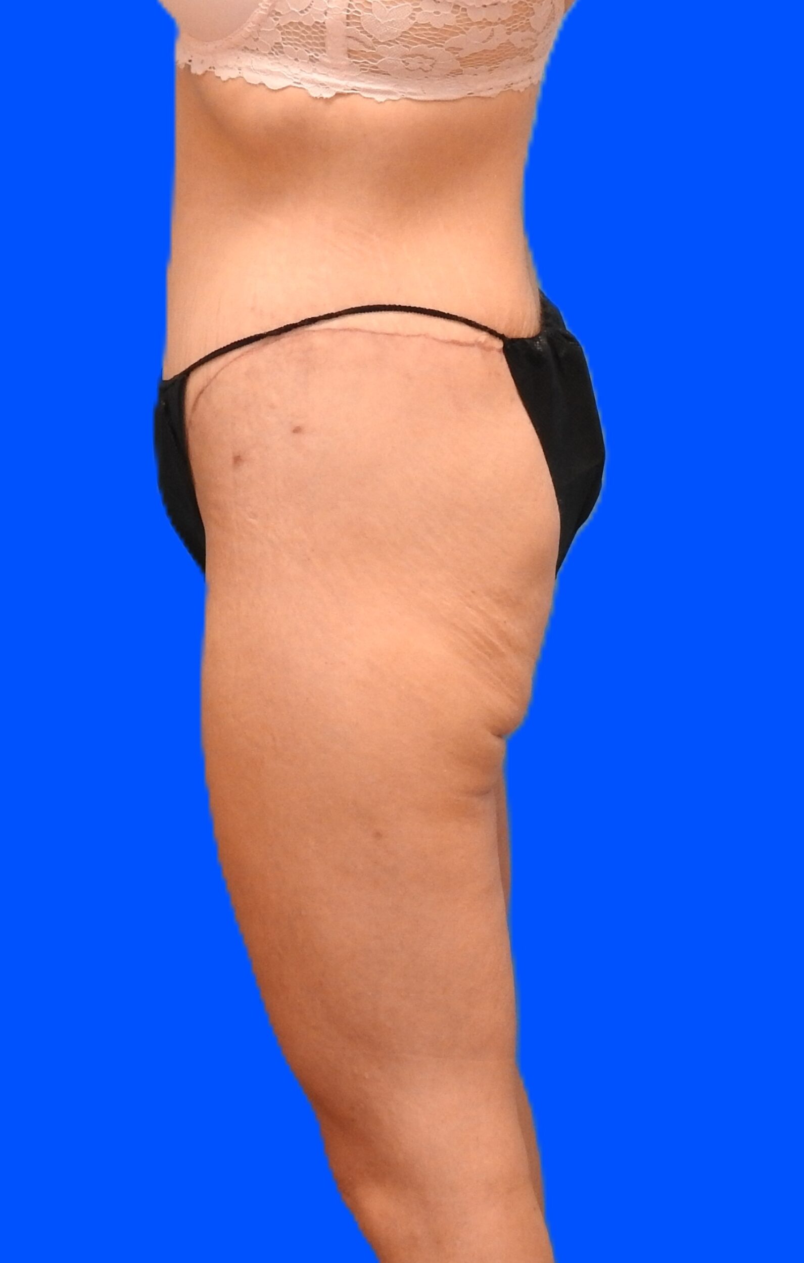 After Image: Patient Case #0144 - left-side