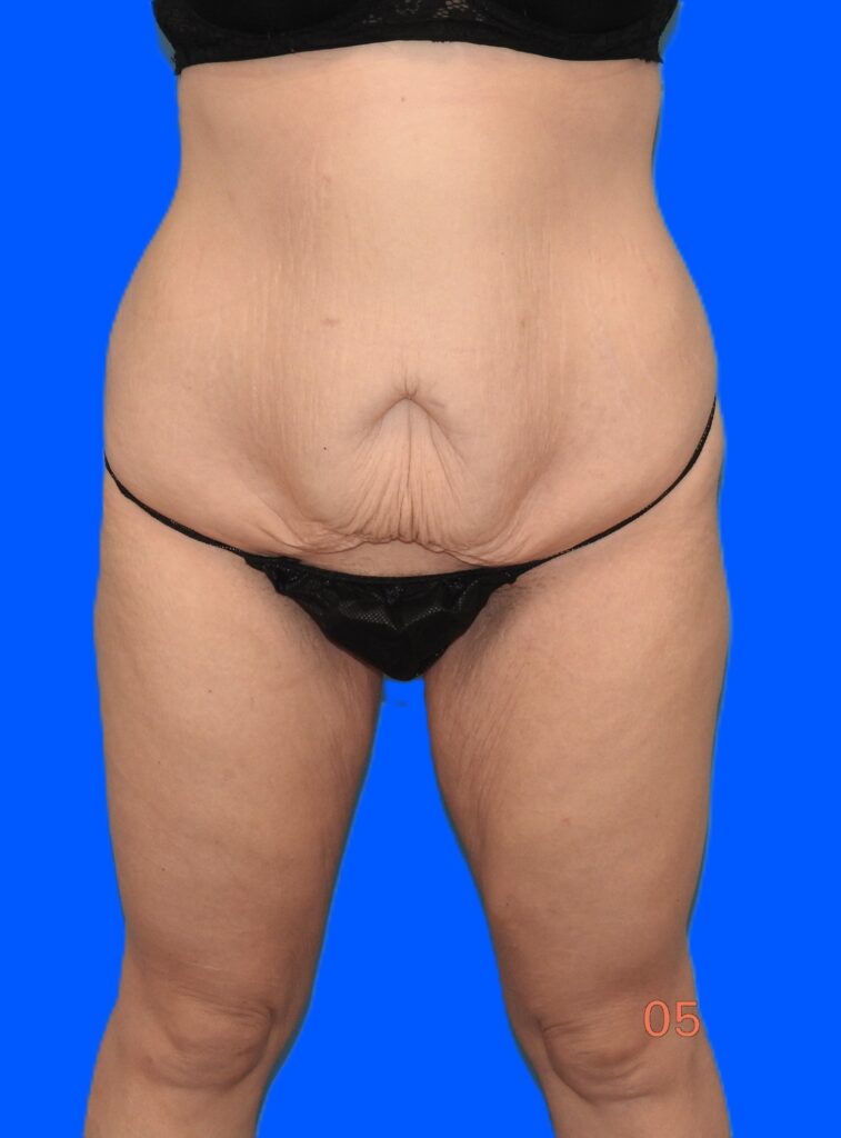 Before Image: Patient Case #0144 - front