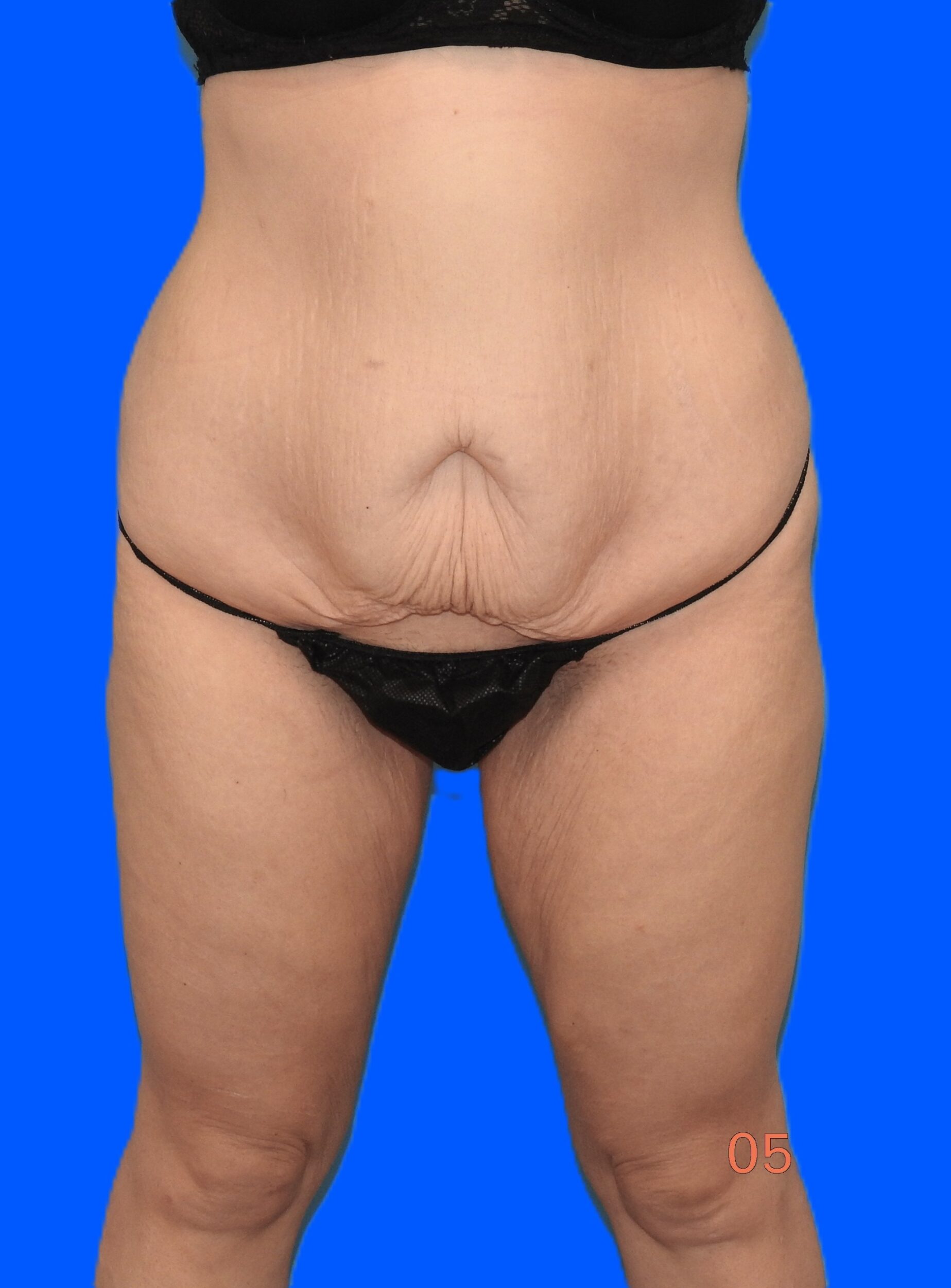 Before Image: Patient Case #0144 - front