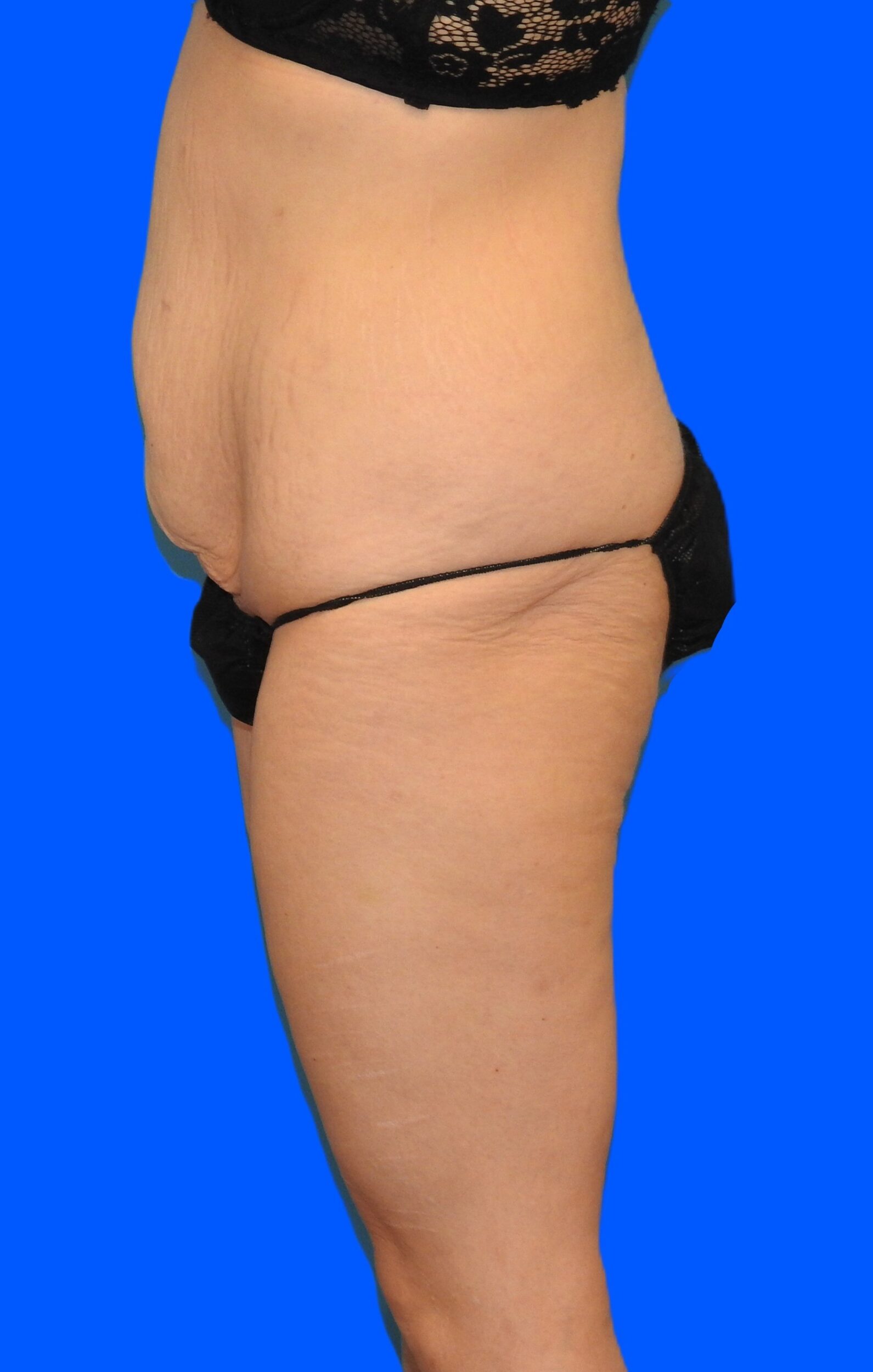 Before Image: Patient Case #0144 - left-side