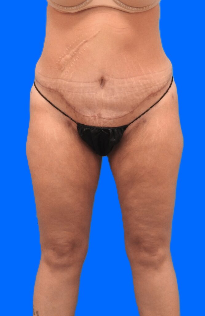 After Image: Patient Case #0145 - front