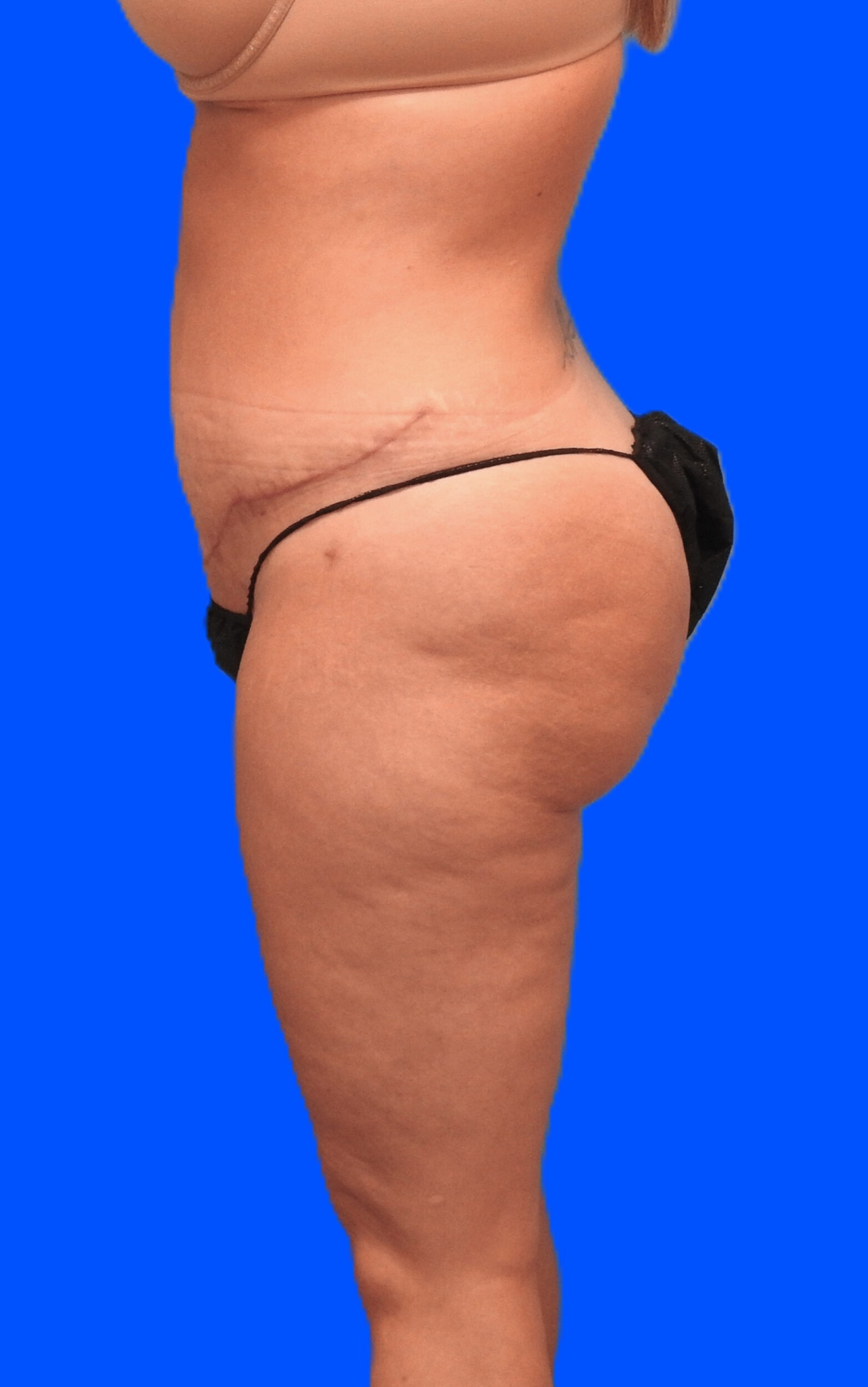 After Image: Patient Case #0145 - left-side