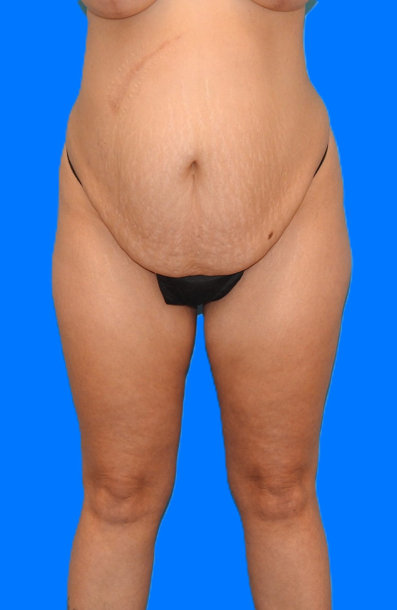 Before Image: Patient Case #0145 - front