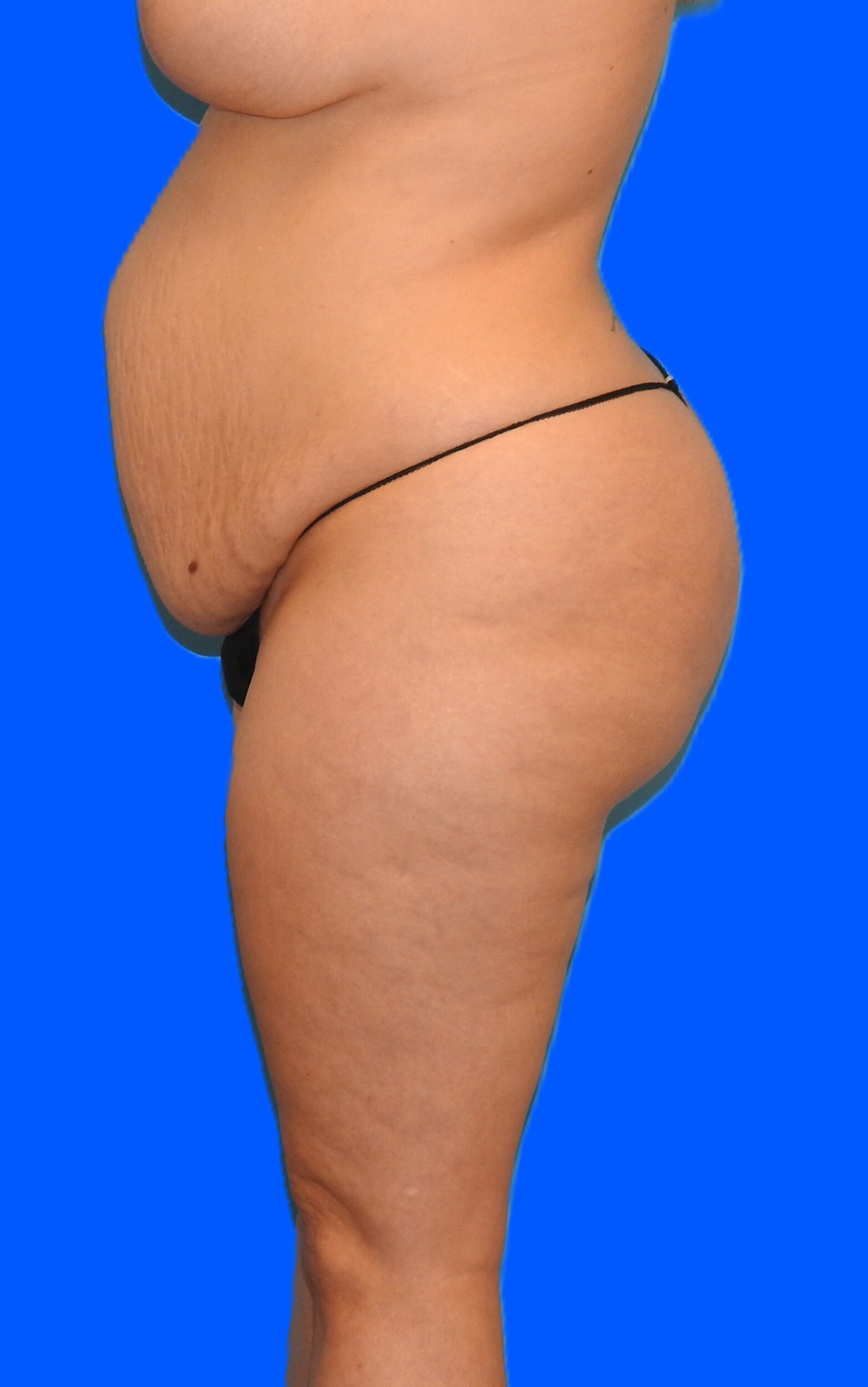 Before Image: Patient Case #0145 - left-side