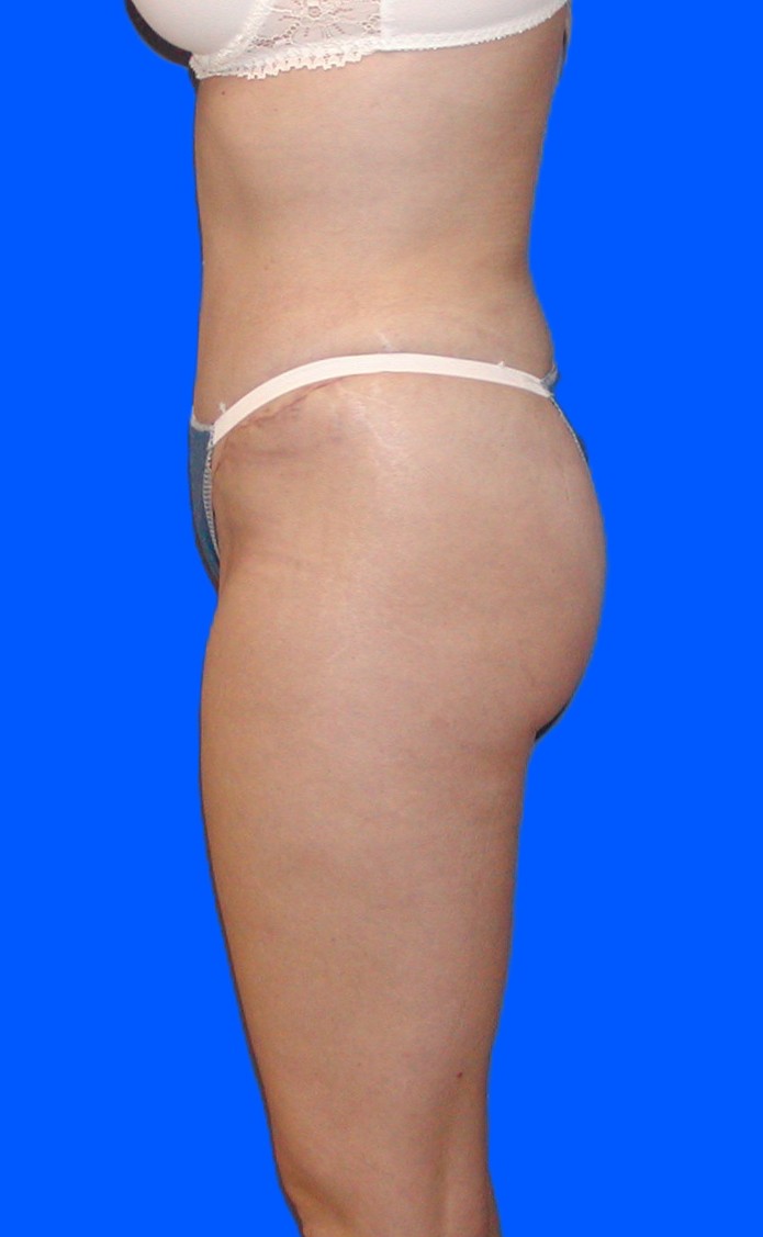 After Image: Patient Case #0146 - left-side