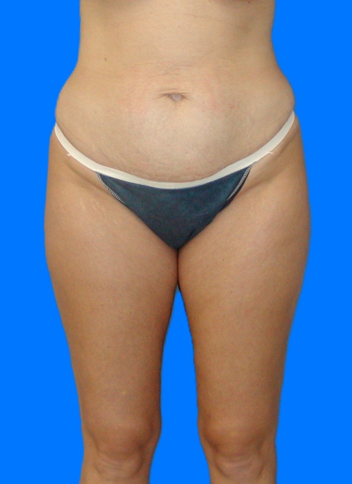 Before Image: Patient Case #0146 - front