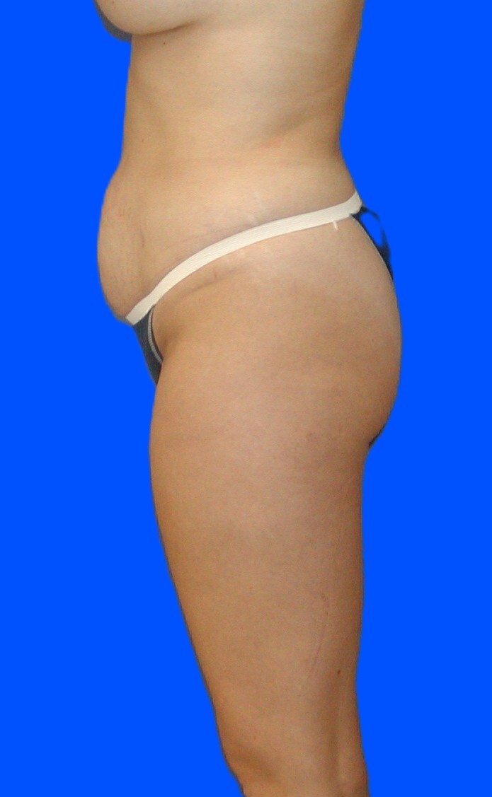 Before Image: Patient Case #0146 - left-side