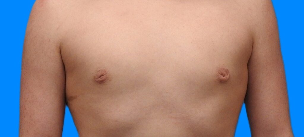 After Image: Patient Case #0147 - front