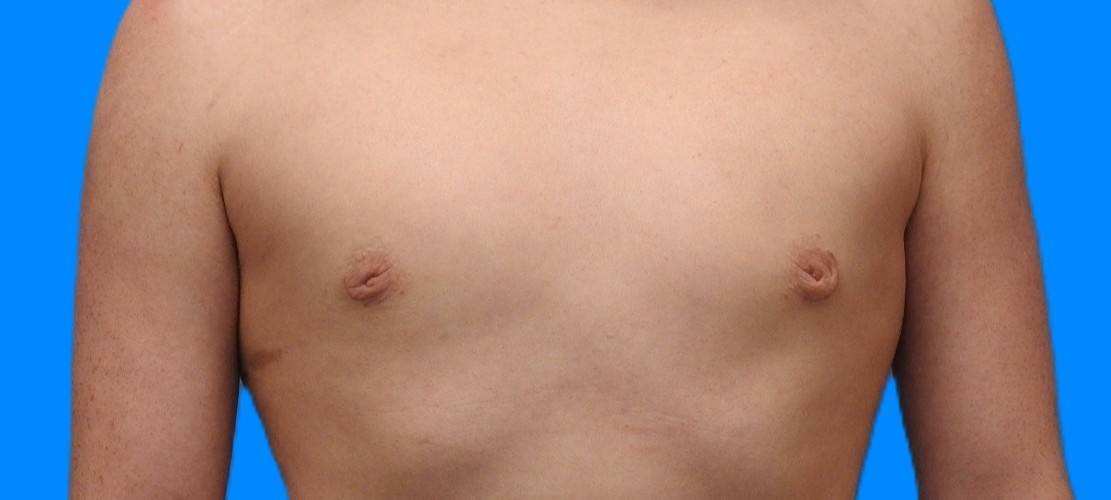 After Image: Patient Case #0147 - front